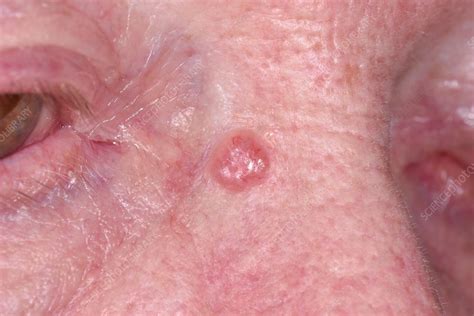 What Is Basal Cell Carcinoma Skin Cancer Images And Photos Finder
