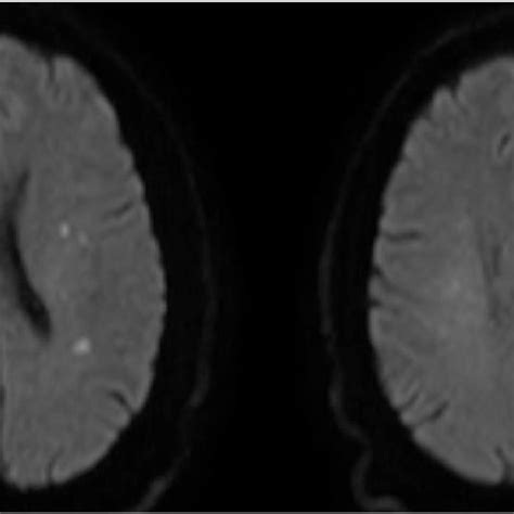 Mri Brain Dwi Showing Tiny Bilateral Cortical Infarcts Download