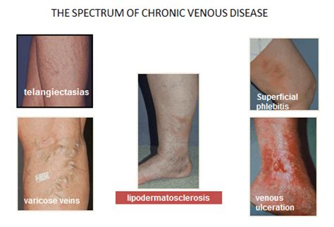 St Louis Chronic Venous Insufficiency Treatment Laser Lipo And Vein