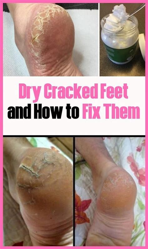 Dry Cracked Feet And Fixing Dry Cracked Feet Cracked Feet Fix It
