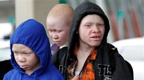 Tanzanian Albino Children Hunted For Body Parts Visit Us For Medical