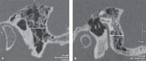 Temporal Bone Posterior Skull Base Posterior Fossa And Cranial