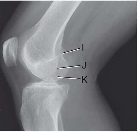 Lateral Knee Radiograph Diagram Quizlet