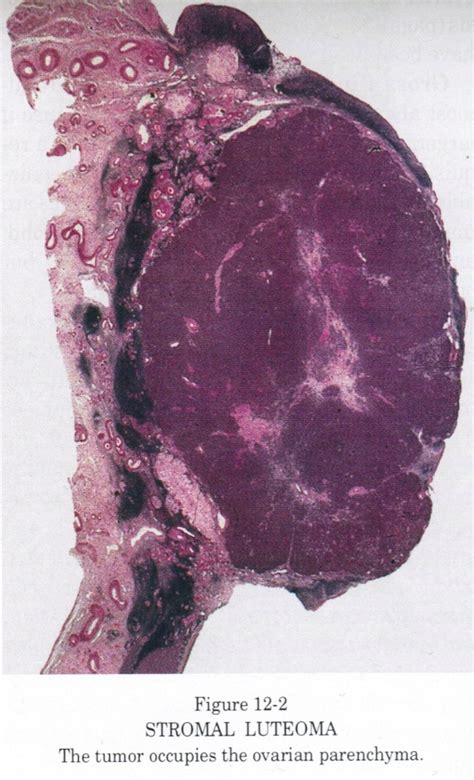 Pathology Outlines Stromal Luteoma