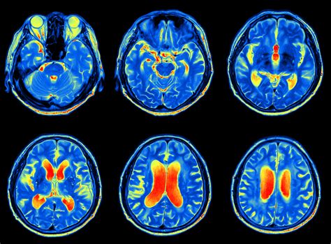 Brain Scans May One Day Be Used To Predict Dementia Health Brain And