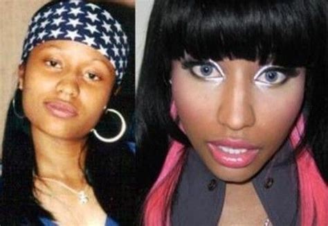 Nicki Minaj Before And After The Surgery Bing Images Plastic