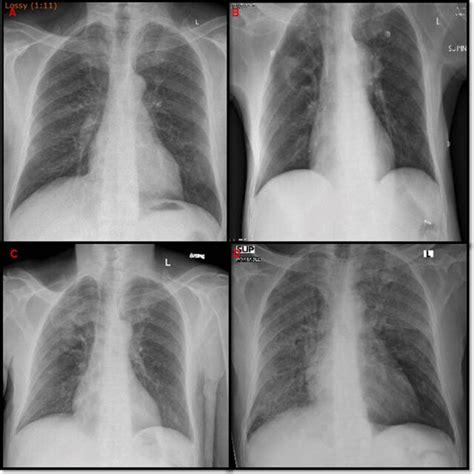 A D Frontal Chest Radiographs Demonstrating Bilateral Diffuse