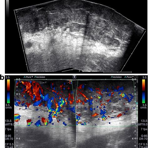 Ultrasound Examination Shows Large Hypoechoic Heterogeneous And
