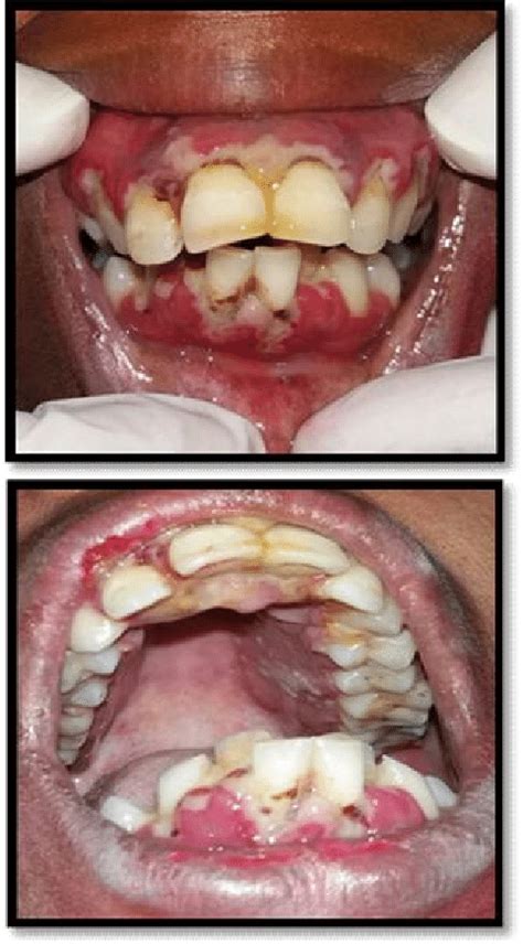 Figure1 A And B Acute Herpetic Gingivostomatitis Showing Minute Vesicles