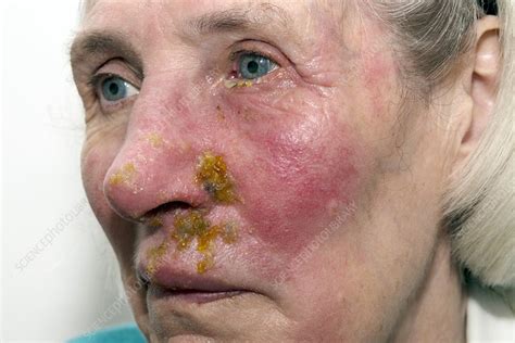 Shingles Rash On The Face Stock Image C0213416 Science Photo Library