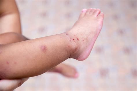 Hand Foot Mouth Disease In Babies And Kids Happiest Baby