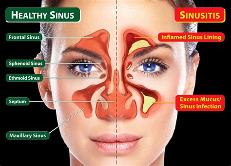 Apa Penyebab Sinusitis