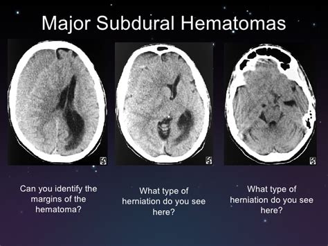 A subdural hematoma (sdh) is a type of bleeding in which a collection of blood—usually associated with a traumatic brain injury—gathers between the inner layer of the dura mater and the arachnoid mater of the meninges surrounding the brain. SUBDURAL VS EPIDURAL HEMATOMA RADIOLOGY - Wroc?awski ...