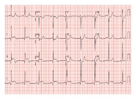 2 Mm St Elevation In Leads Ii Iii And Avf Download Scientific Diagram