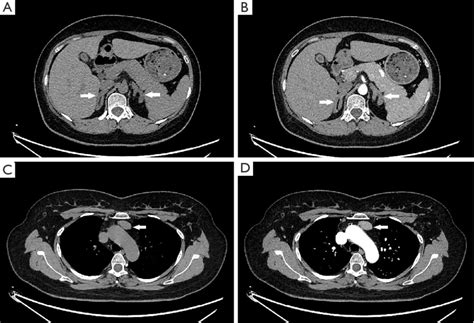 Adrenal And Chest Plain And Enhanced Ct Scan Preoperative A Plain Ct