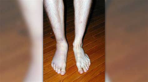 Sprained Ankle Causes And Symptoms General Center