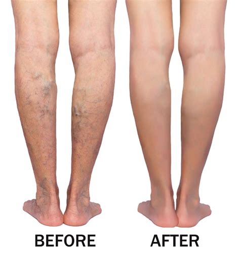 Varicose Veins Before After Cardiovascular Labs Of America