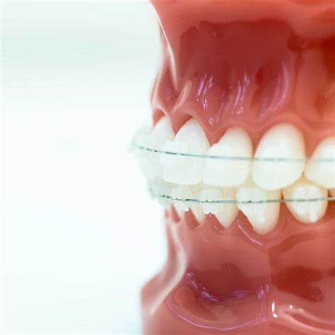 3m Clarity Clear Braces Larson Orthodontics In Alexandria Va