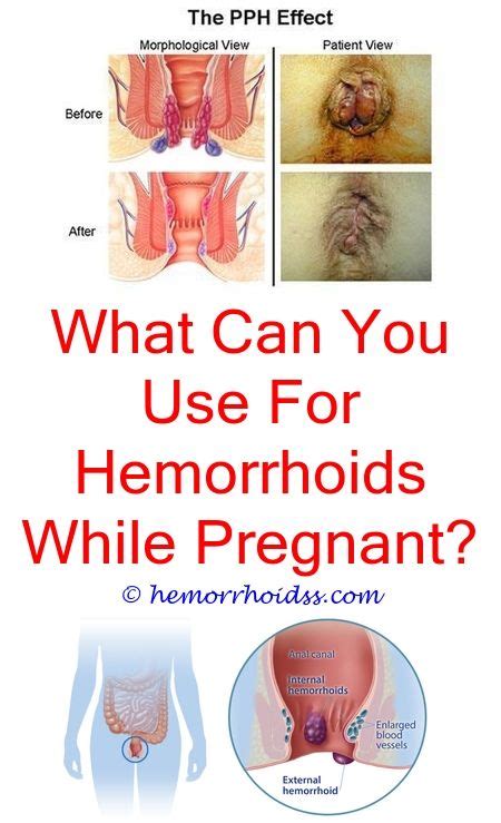 How To Shrink Hemorrhoids Overnight Bleeding Hemorrhoids