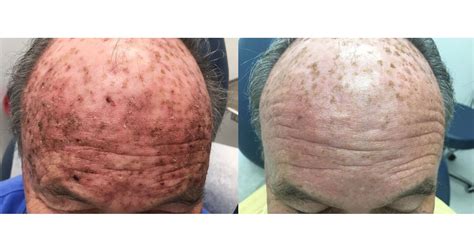 Before And After Dermassociates Rockville Us Dermatology Partners