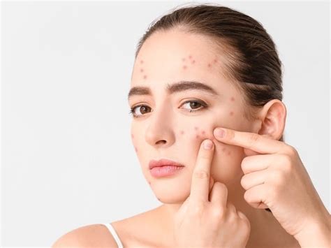 How To Address Acne With Or Without A Dermatologists Assistance