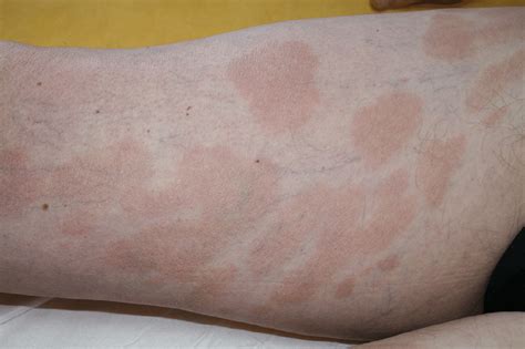 Mycosis Fungoides Patches Stage Download Scientific Diagram