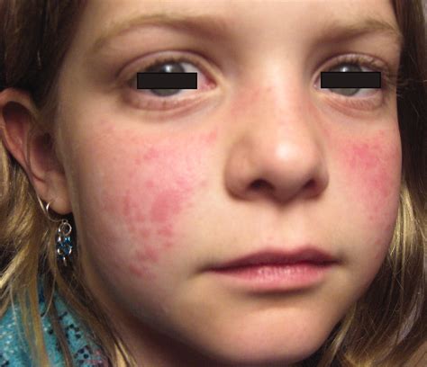 Malar Rash In Systemic Juvenile Idiopathic Arthritis The Journal Of