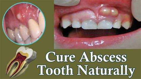 Best Treatment For Tooth Abscess Cure Your Abscess Naturally At Home