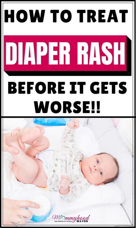 How To Treat Diaper Rash In A Newborn Baby Diaper Rash Baby Diaper