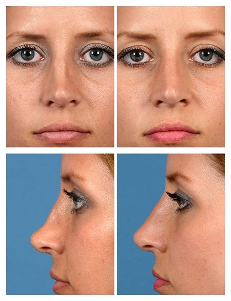 Liquid Rhinoplasty Before And After Pictures