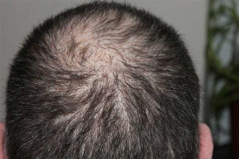 Hair Loss Causes Diseases And Conditions Male And Female Find