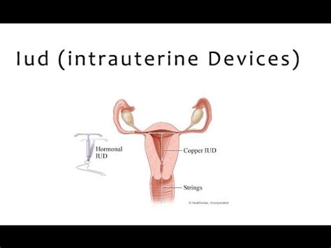 How do i use an iud? All about IUD (How does a Copper T work ?) - By indus womenchannel - YouTube