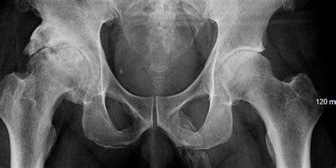 Penile Ossification Mans Penis Turning To Bone From Rare Disease