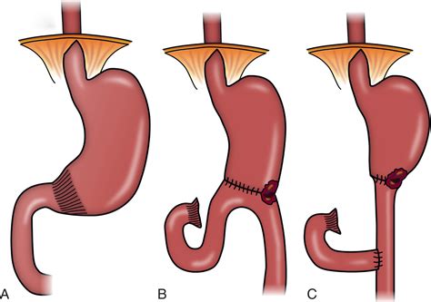 Retained Gastric Antrum Syndrome Surgical Focus