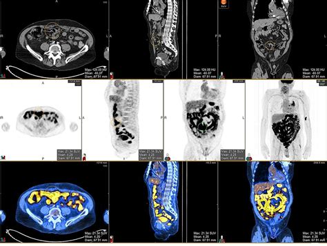 Diffuse Bowel Uptake Of 18f Fdg On Petct Examination Of A Patient With