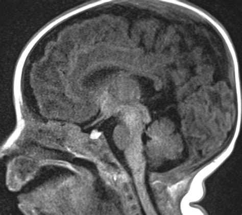 Learning Neuroradiology Case 2257 Mri Neonatal Brain