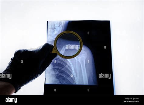 X Ray Image Broken Human Collarbone Is Viewed Through Magnifying Glass