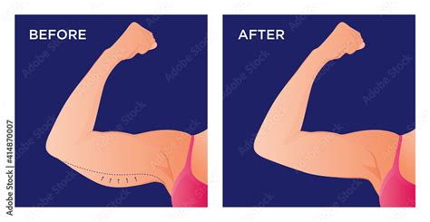 Arm With Excess Skin Before And After Surgical Operation Saggy Skin