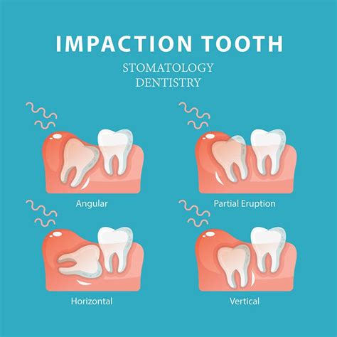 Laser Treatment For Wisdom Tooth Pain Dr Sana Farista