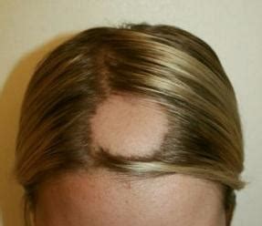 Elle peut être irréversible et provoquer un affinement du cheveu. Chute de cheveux et pelade : une solution avec l ...