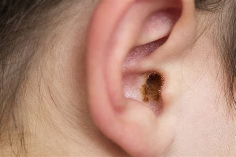 Laxative Helps Remove Earwax The Peoples Pharmacy