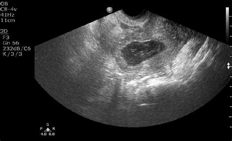 Abnormal Uterus Ultrasound