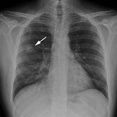 Cureus Delayed Diagnosis Of An Atypical Pneumonia Resembling A