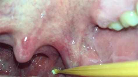 Tonsil Stone Extraction Youtube