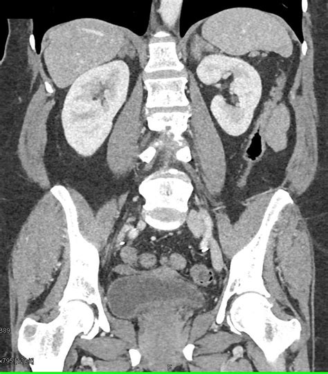 Bilateral Adrenal Hyperplasia Adrenal Case Studies Ctisus Ct Scanning