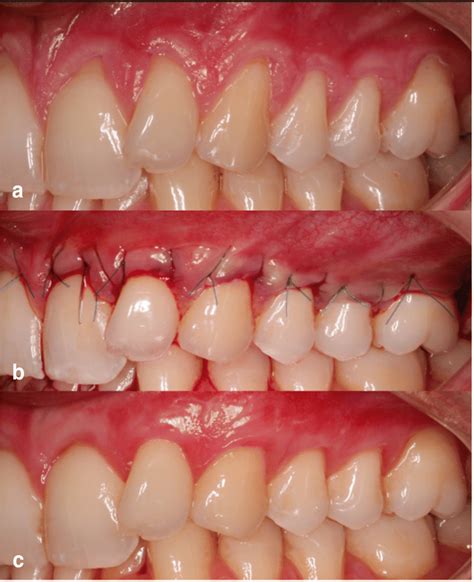 A Pre Operative View Of Gingival Recessions In Control Side B