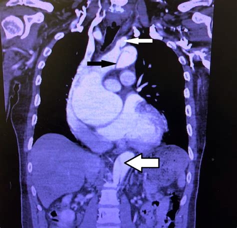 Cureus Large Vessel Occlusion Stroke Secondary To Acute Aortic Dissection