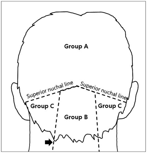 To Divide Three Groups According To Anatomical Locations Of The Scalp