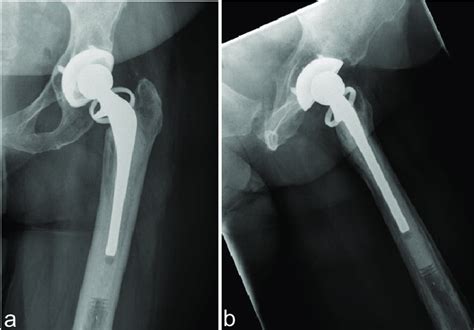 Pre Operative Anteroposterior A And Lateral B Hip Radiographs