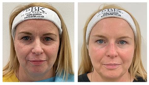 Facelift Threading Before And After